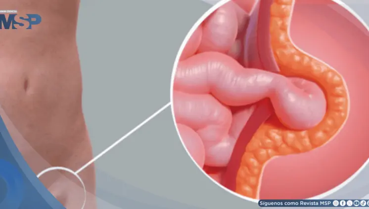 Dolor, bulto y molestias al esforzarse: Síntomas clave de una hernia que no debe ignorar