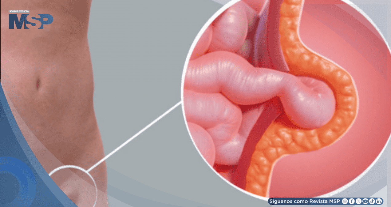Dolor, bulto y molestias al esforzarse: Síntomas clave de una hernia que no debe ignorar