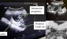 Describen embarazo heterotópico con ruptura tubárica en paciente con antecedentes de mutilación genital