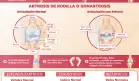 IMPACTO DE LA ARTROSIS EN LAS ARTICULACIONES
