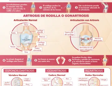 IMPACTO DE LA ARTROSIS EN LAS ARTICULACIONES