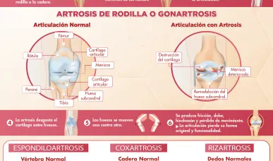 IMPACTO DE LA ARTROSIS EN LAS ARTICULACIONES