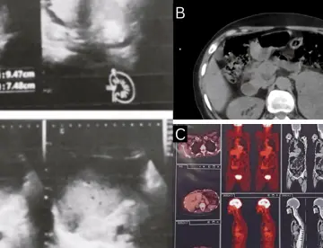 Secreción de aldosterona en mujer con carcinoma de células renales y  metástasis suprarenal contralateral