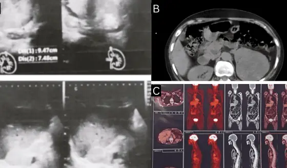 Secreción de aldosterona en mujer con carcinoma de células renales y  metástasis suprarenal contralateral