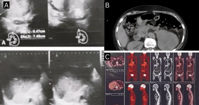 Secreción de aldosterona en mujer con carcinoma de células renales y  metástasis suprarenal contralateral