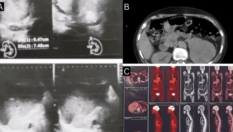 Secreción de aldosterona en mujer con carcinoma de células renales y  metástasis suprarenal contralateral