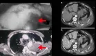 Hematoma extrapleural en paciente con disección aórtica aguda diagnosticada tras dolor abdominal 