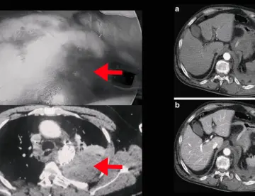Hematoma extrapleural en paciente con disección aórtica aguda diagnosticada tras dolor abdominal 