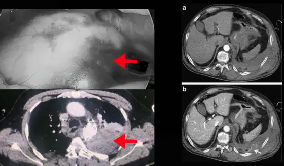 Hematoma extrapleural en paciente con disección aórtica aguda diagnosticada tras dolor abdominal 