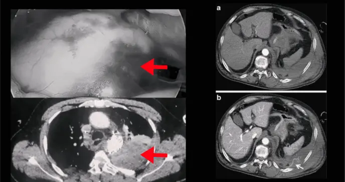 Hematoma extrapleural en paciente con disección aórtica aguda diagnosticada tras dolor abdominal 