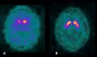 Hombre de 52 años con esquizofrenia tratado con antipsicóticos desarrolla parkinsonismo idiopático 