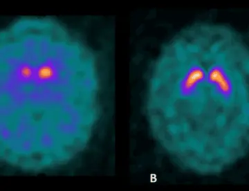 Hombre de 52 años con esquizofrenia tratado con antipsicóticos desarrolla parkinsonismo idiopático 