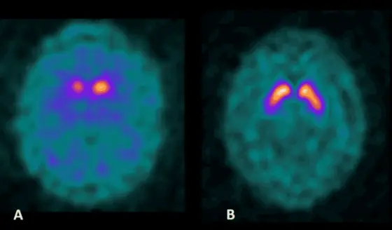 Hombre de 52 años con esquizofrenia tratado con antipsicóticos desarrolla parkinsonismo idiopático 