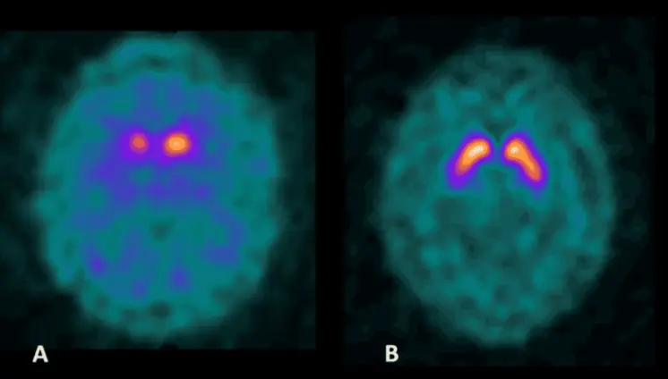 Hombre de 52 años con esquizofrenia tratado con antipsicóticos desarrolla parkinsonismo idiopático 
