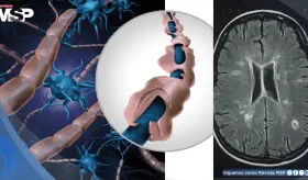 Identifican biomarcadores en sangre y líquido cefalorraquídeo que predicen la esclerosis múltiple