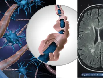 Identifican biomarcadores en sangre y líquido cefalorraquídeo que predicen la esclerosis múltiple