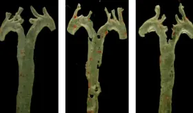 Revolución en la medicina: una molécula producida por bacterias del intestino causa la aterosclerosis