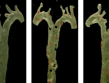 Revolución en la medicina: una molécula producida por bacterias del intestino causa la aterosclerosis