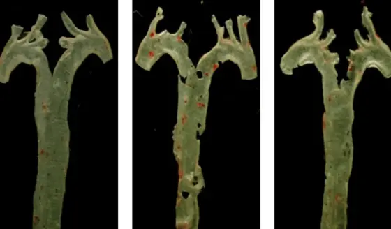 Revolución en la medicina: una molécula producida por bacterias del intestino causa la aterosclerosis
