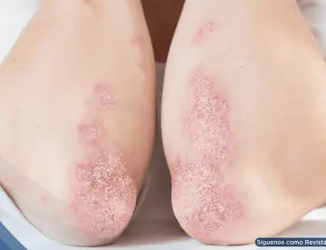 Consenso sobre tratamiento de la psoriasis en placas: Definen la remisión