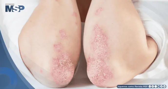 Consenso sobre tratamiento de la psoriasis en placas: Definen la remisión