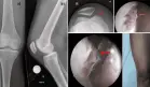 Mujer desarrolla artritis séptica con infección articular por Enterococcus faecium tras picotazo de gallo
