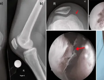 Mujer desarrolla artritis séptica con infección articular por Enterococcus faecium tras picotazo de gallo