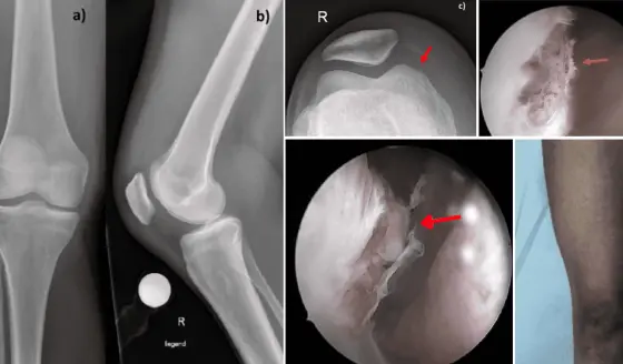 Mujer desarrolla artritis séptica con infección articular por Enterococcus faecium tras picotazo de gallo