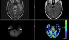 Necrosis del lóbulo temporal como complicación tardía de radioterapia en carcinoma nasofaríngeo