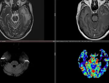 Necrosis del lóbulo temporal como complicación tardía de radioterapia en carcinoma nasofaríngeo