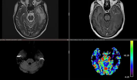 Necrosis del lóbulo temporal como complicación tardía de radioterapia en carcinoma nasofaríngeo