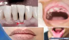 Xerostomía, gingivitis y pérdida dental como efectos secundarios de los antipsicóticos en la salud bucal