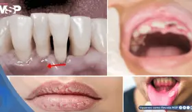 Xerostom&iacute;a, gingivitis y p&eacute;rdida dental: posibles complicaciones  asociadas al uso de antipsic&oacute;ticos