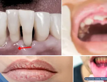 Xerostomía, gingivitis y pérdida dental: posibles complicaciones  asociadas al uso de antipsicóticos