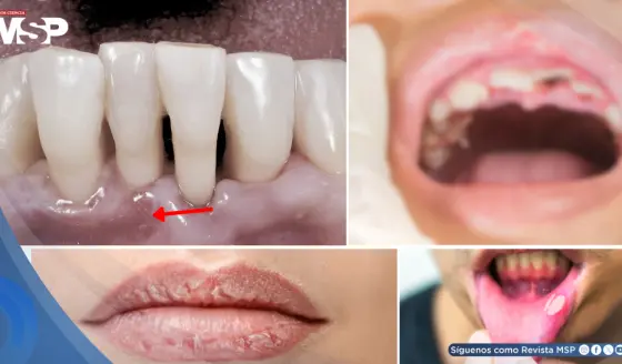Xerostomía, gingivitis y pérdida dental como efectos secundarios de los antipsicóticos en la salud bucal