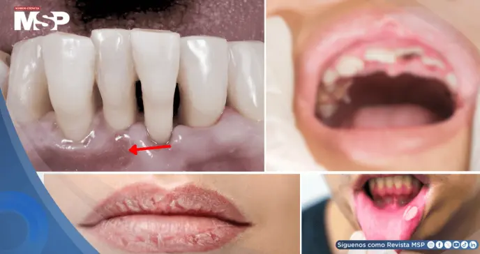Xerostomía, gingivitis y pérdida dental como efectos secundarios de los antipsicóticos en la salud bucal