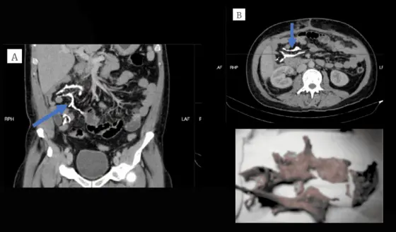Detectan formación anormal de hueso en el mesenterio de un paciente con ileostomía durante una tomografía