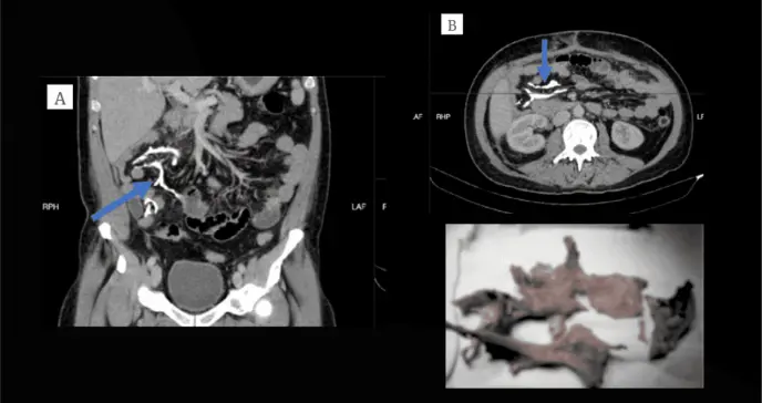 Detectan formación anormal de hueso en el mesenterio de un paciente con ileostomía durante una tomografía