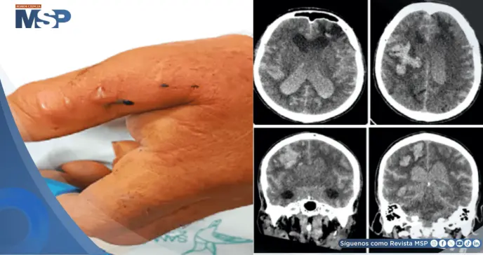 Mordedura de serpiente mapaná desencadena hemorragia intracerebral mortal en paciente adulto mayor