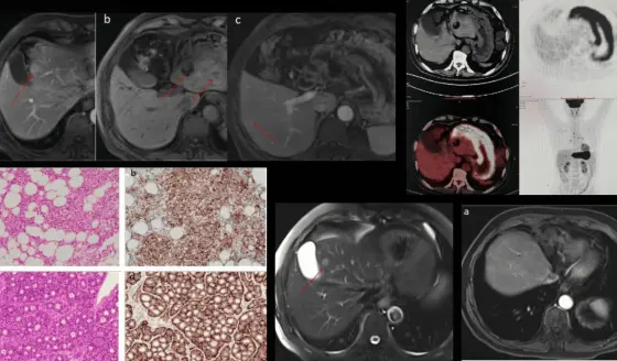 Dolor abdominal y diarrea revelan tumor neuroendocrino hepático en hombre de 70 años