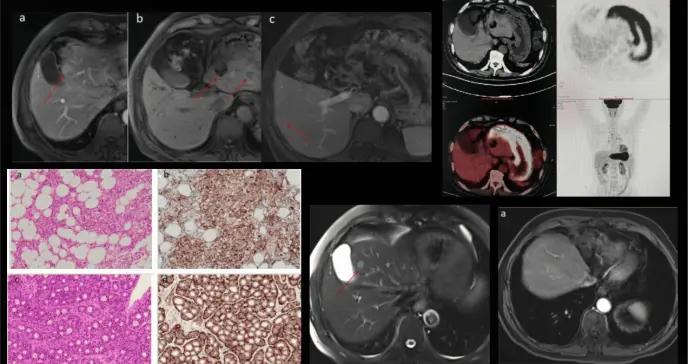 Dolor abdominal y diarrea revelan tumor neuroendocrino hepático en hombre de 70 años