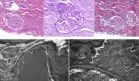 Insuficiencia renal progresiva en paciente en embarazo revela glomeruloesclerosis segmentaria focal
