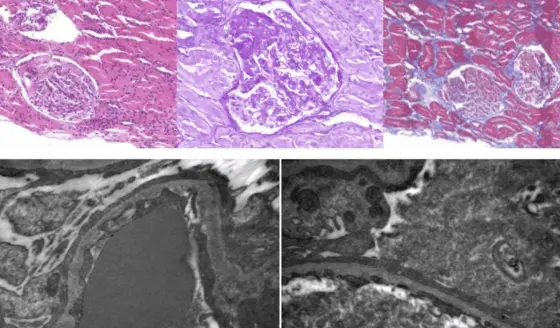 Insuficiencia renal progresiva en paciente en embarazo revela glomeruloesclerosis segmentaria focal
