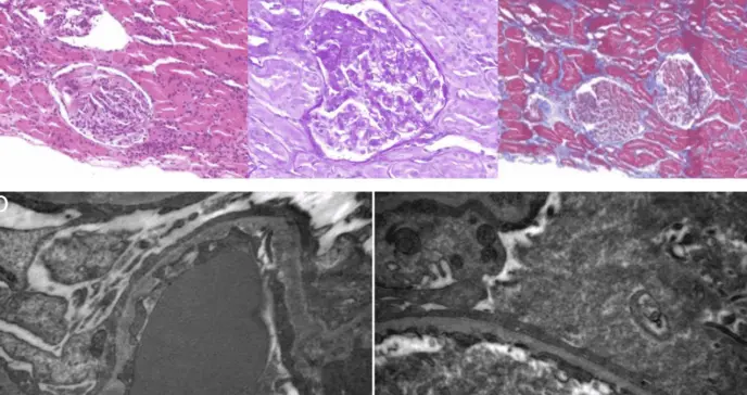 Insuficiencia renal progresiva en paciente en embarazo revela glomeruloesclerosis segmentaria focal