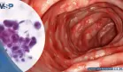 Científicos descubren que la proteína STING desencadena la inflamación en la colitis ulcerosa