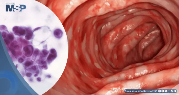 Científicos descubren que la proteína STING desencadena la inflamación en la colitis ulcerosa