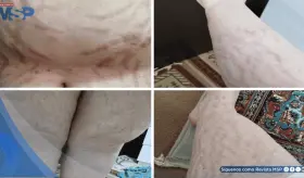 Obesidad, estrías de color e hirsutismo revelan Síndrome de Cushing asociado a uso de gotas nasales