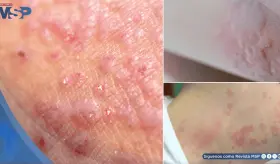 Dermatitis y urticaria solar: por qué tu piel reacciona como si le tuvieras ´alergia´ al sol