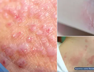 Dermatitis y urticaria solar: por qué tu piel reacciona como si le tuvieras ‘alergia’ al sol