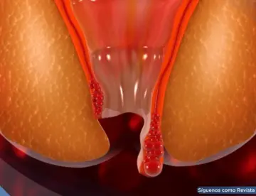 Hemorroides: qué son, por qué aparecen y cómo aliviar el dolor efectivamente